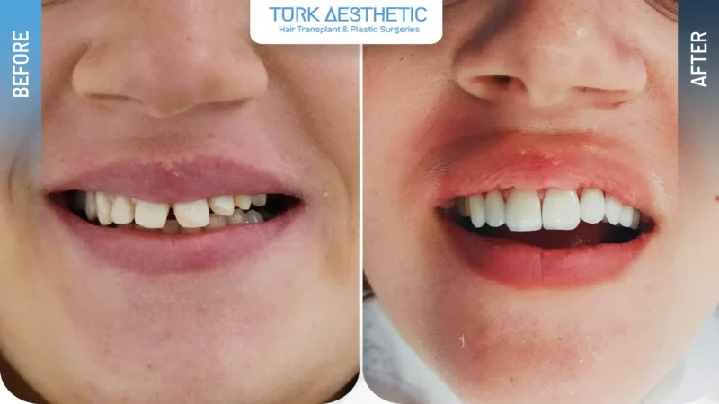 Faccette dentali prima e dopo, risultato estetico dei denti
