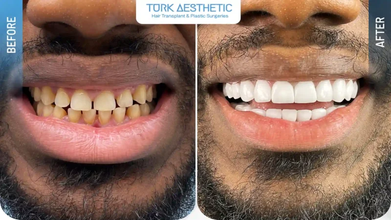 Faccette dentali prima e dopo, sorriso dall'aspetto naturale