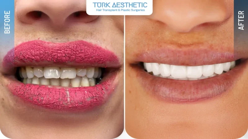 Faccette dentali prima e dopo, aspetto del sorriso e dei denti