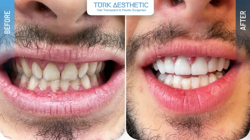 Faccette dentali prima e dopo, aspetto del sorriso