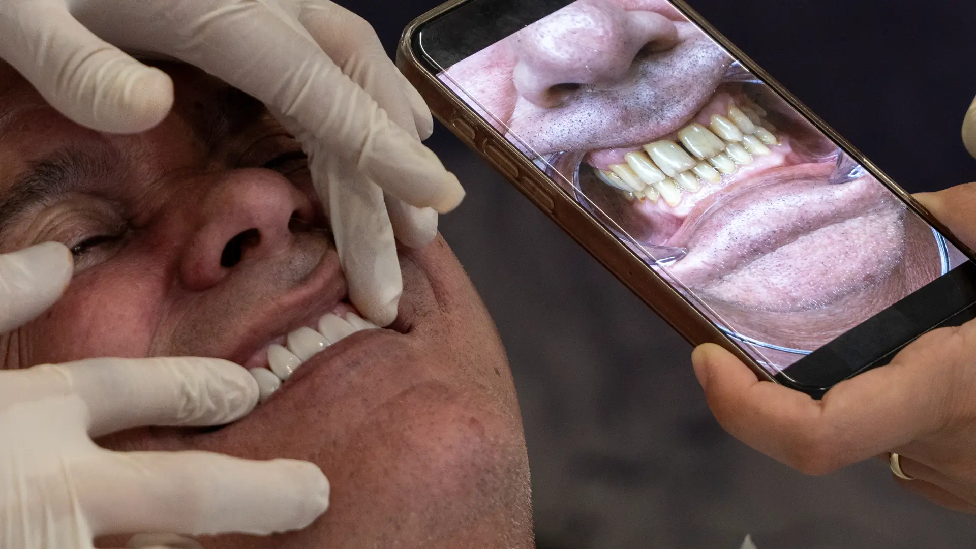 Veneers für ein natürliches und ästhetisches Lächeln