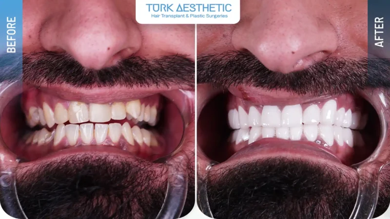 Gülüş tasarımı öncesi ve sonrası dişlerin görünümündeki estetik değişim