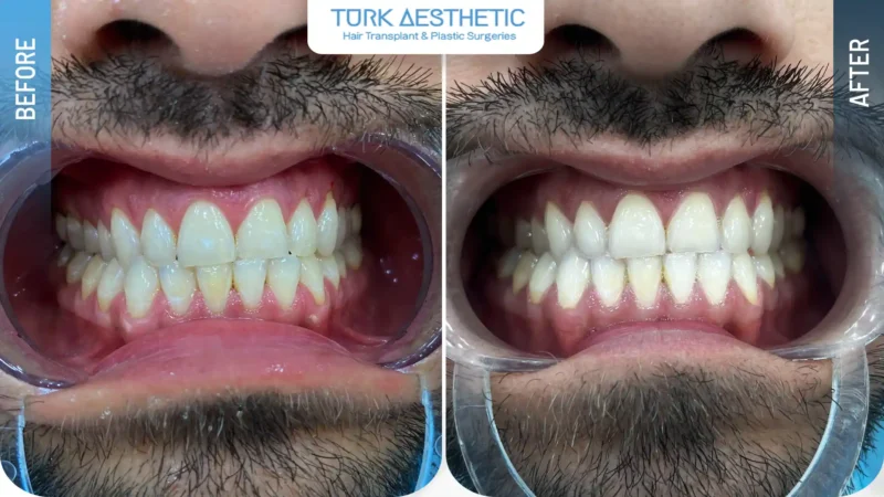Schiarimento del colore dei denti prima e dopo lo sbiancamento dentale
