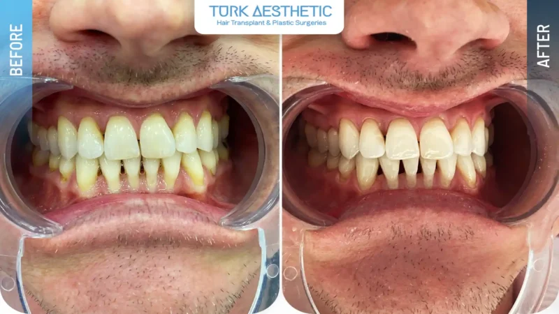 Cambiamento della tonalità dei denti prima e dopo lo sbiancamento dentale