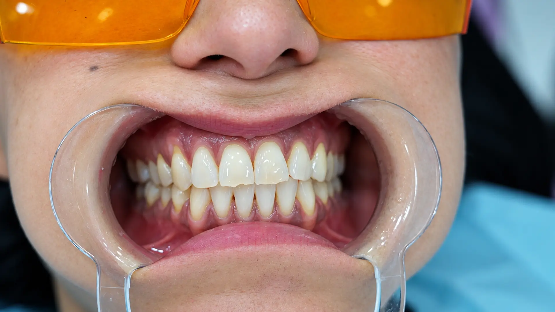 Valutazione dei denti prima dello sbiancamento dentale