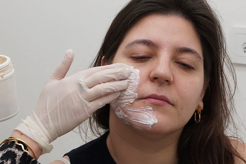 CO2 fraksiyonel lazer işlemi öncesinde lokal anestezi uygulaması