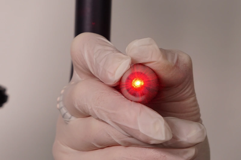 CO2 lazer cihazı kullanılarak ben aldırma işleminin uygulanması