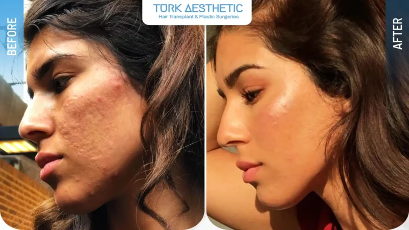 Fraksiyonel lazer öncesi ve sonrası cilt dokusunun karşılaştırmalı fotoğrafları